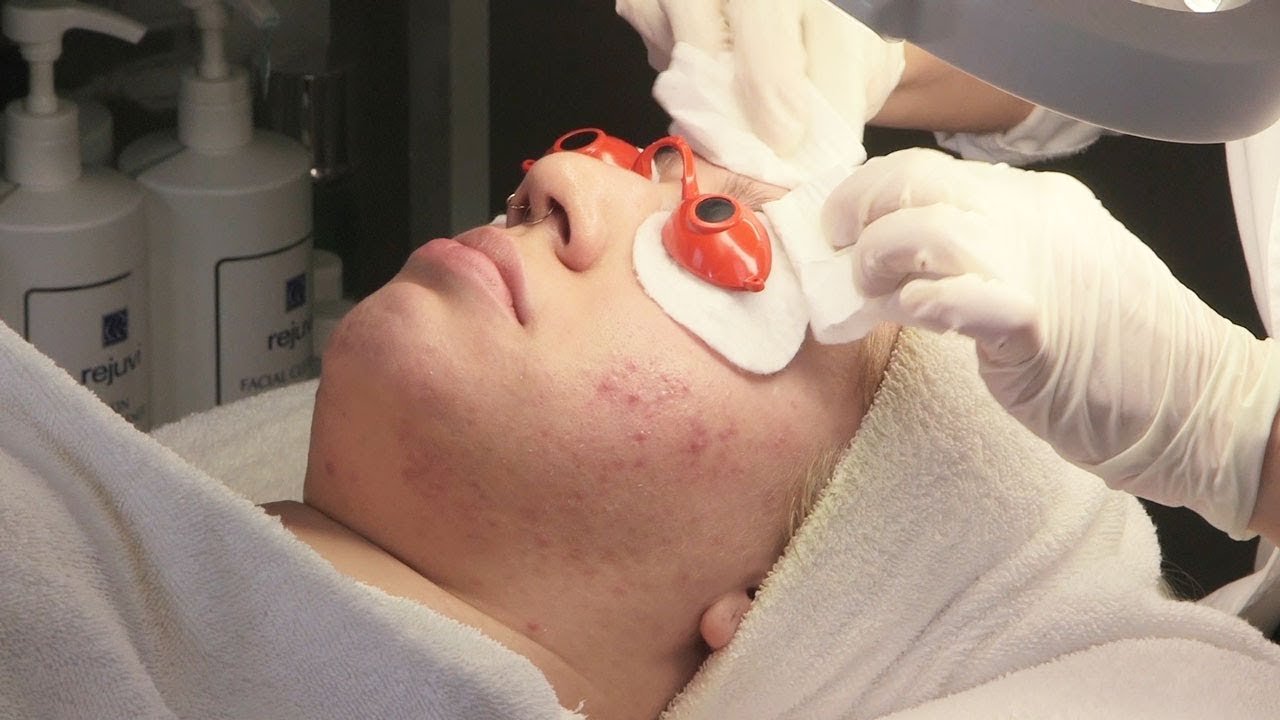 Acne Treatment
