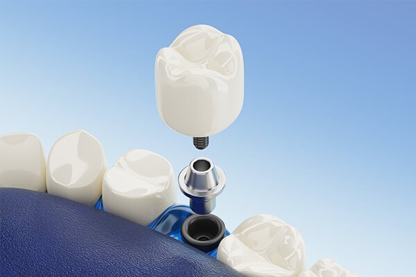 Replace Missing Teeth